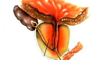 What is prostatitis in men