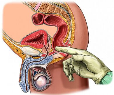 Prostate examination on the finger