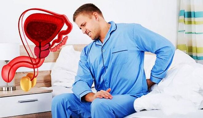 Lower back pain due to prostatitis